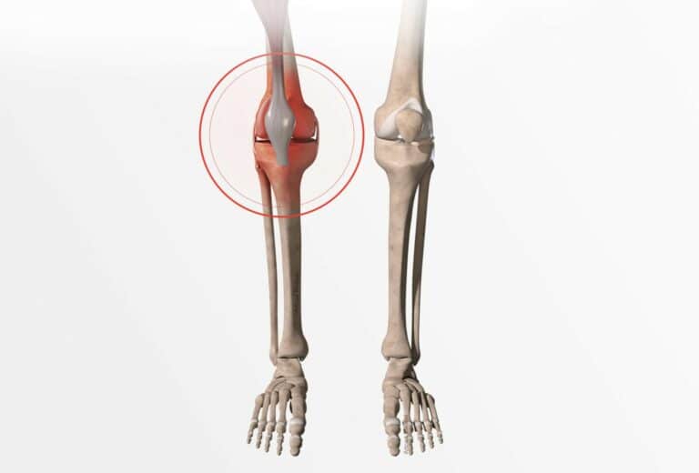 Définition symptômes et diagnostic de la fracture du genou Dr Paillard