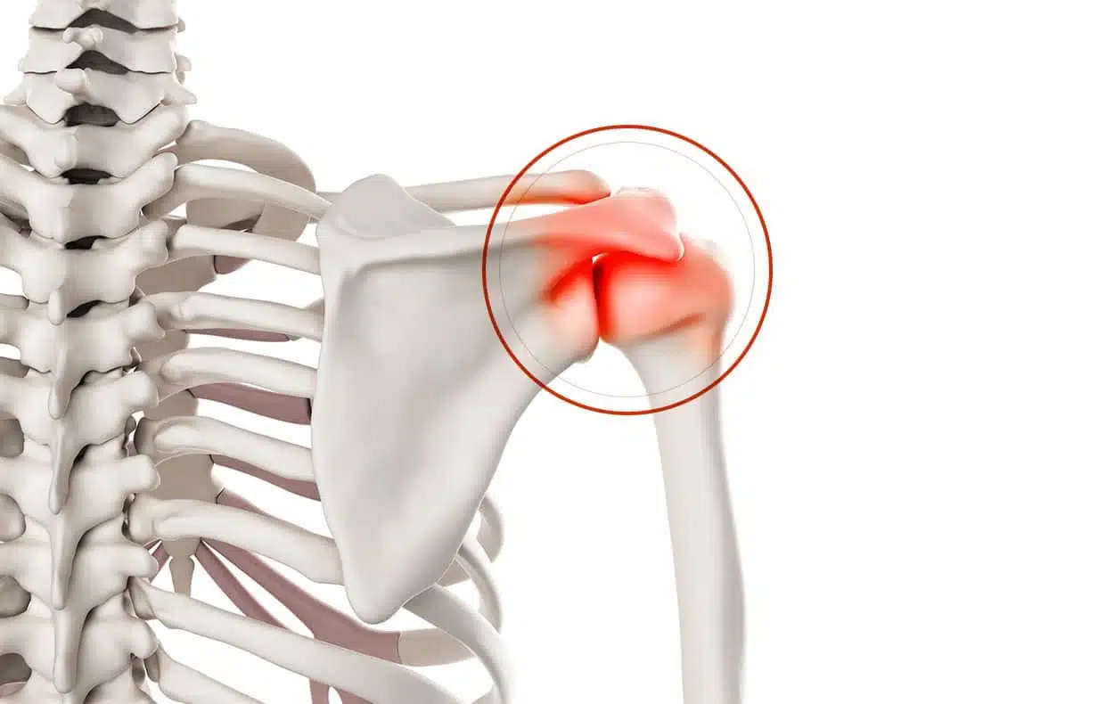 Chirurgie de l’épaule à Paris: Acromioplastie de l’épaule - Dr Paillard, Chirurgien orthopédique