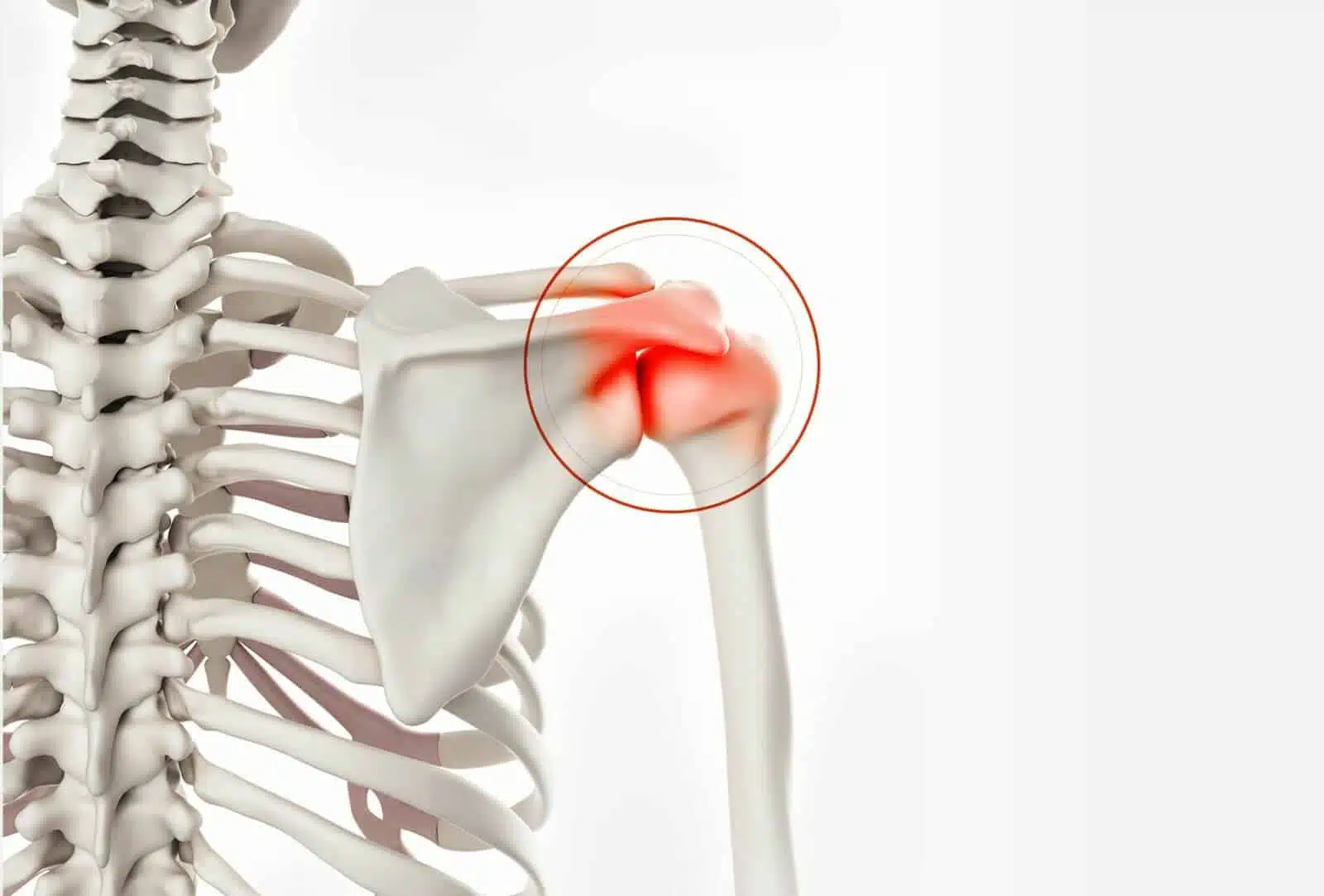 Chirurgie de l’épaule à Paris: Résection acromio claviculaire - Dr Paillard Paris