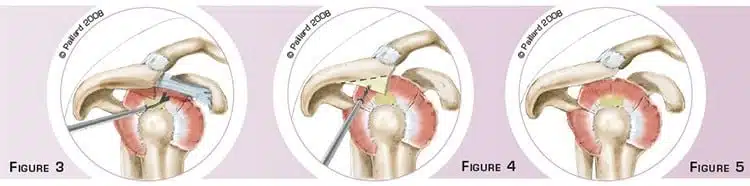 Acromioplastie de l’épaule à Paris par docteur Paillard: Chirurgien orthopédique