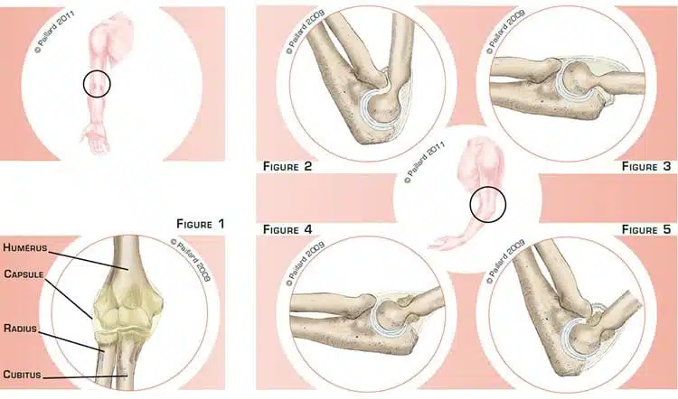 Qu’est-ce qu’une raideur du coude? Définition par dr Paillard: Chirurgien orthopédique