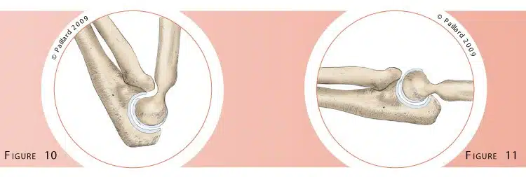 Chirurgie du coude (Arthrolyse du coude) à Paris par docteur Paillard