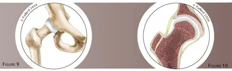 Qu’est ce qu’une arthroscopie de la hanche? Définition par dr Paillard: Chirurgien orthopédique