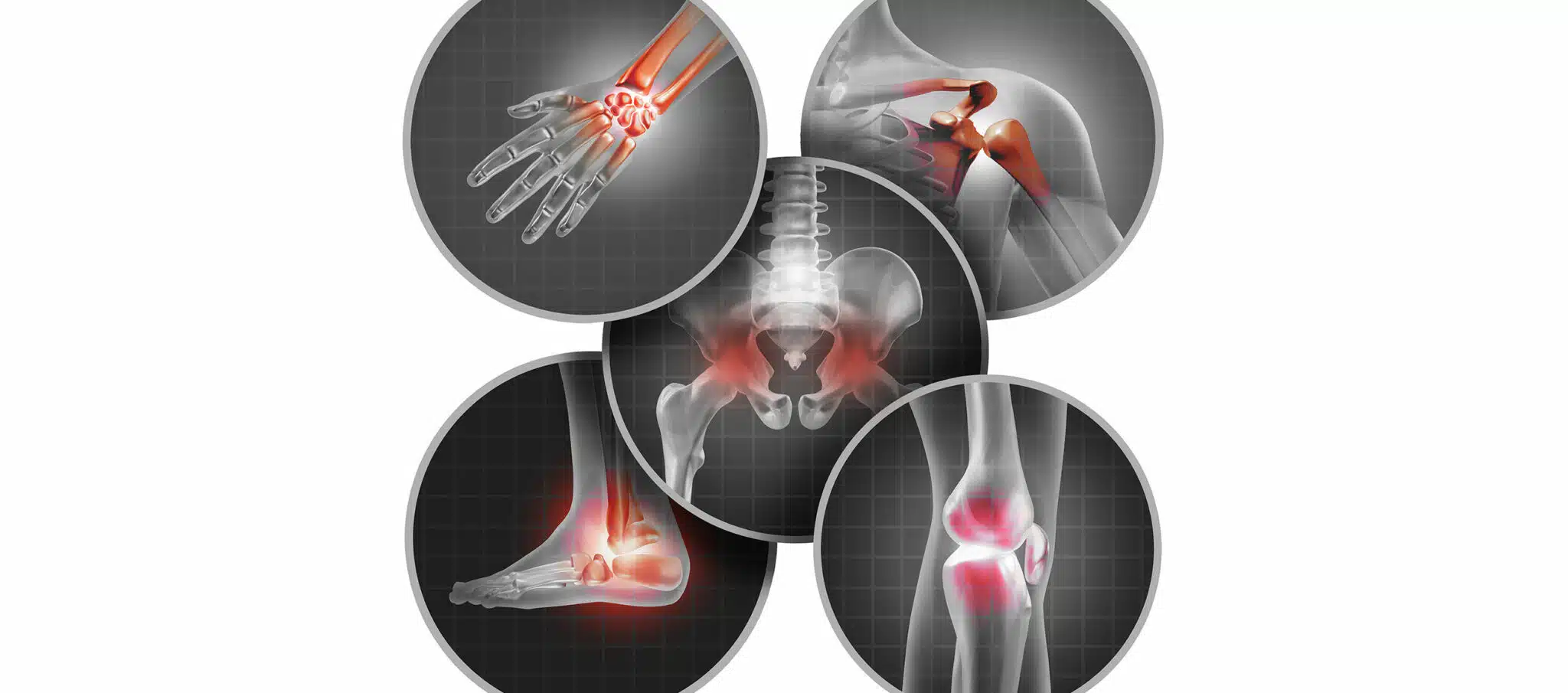 Arthrose (usure des cartilages): Causes - Symptômes et Traitement à Paris - dr Paillard