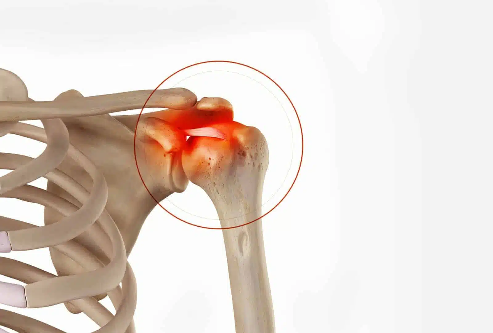 Chirurgie de l’épaule à Paris: Calcification des tendons de l’épaule - Dr Paillard