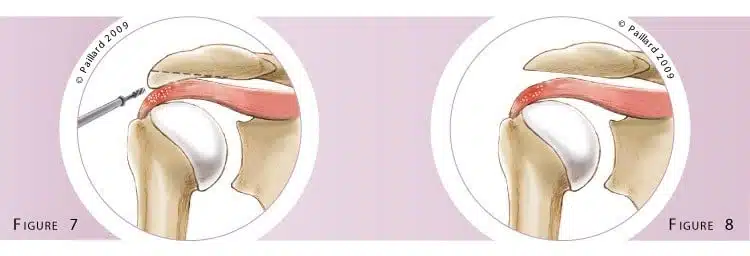 Traitement des calcifications de l’épaule à Paris - Dr Paillard, Chirurgien orthopédique