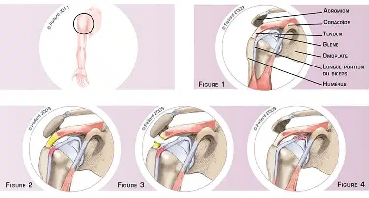 Qu’est ce qu’une lésion du biceps au niveau de l’épaule? Définition par dr Paillard