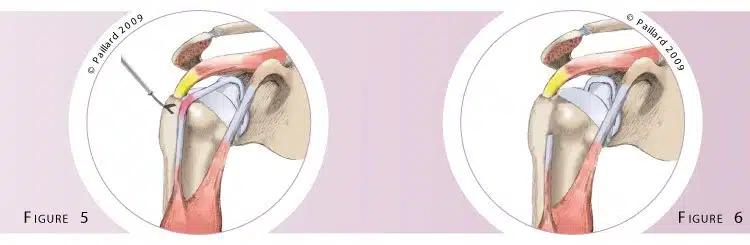 Qu’est ce qu’une chirurgie du biceps? Définition par dr Paillard