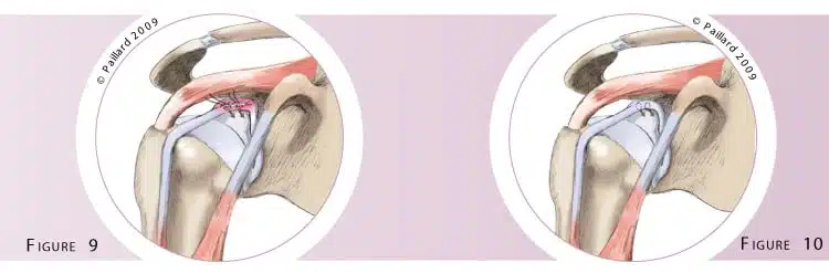 Chirurgie du biceps au niveau de l’épaule à Paris par Dr Paillard