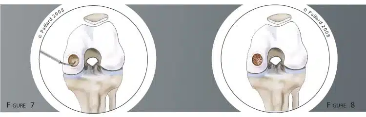 Traitement de la lésion cartilagineuse des genoux à Paris - Dr Paillard