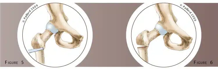 Chirurgie de la hanche (Chirurgie conservatrice) à Paris - Dr Paillard