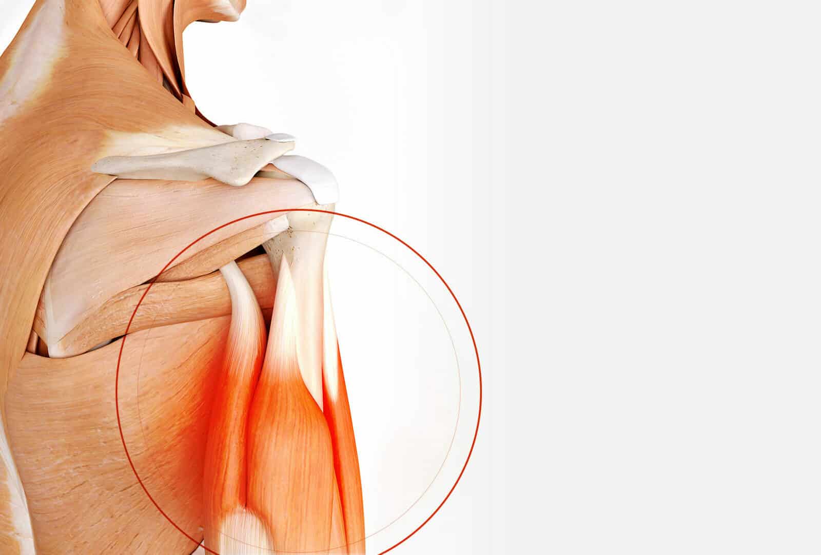 Chirurgie de l’épaule: Chirurgie du biceps à Paris - Dr Paillard