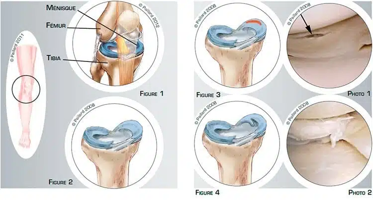 Qu’est ce qu’une lésion méniscale? Définition par docteur Paillard, Chirurgien orthopédique