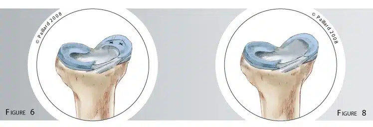 Qu’est ce qu’une chirurgie méniscale? Définition par dr Paillard, Chirurgien orthopédique