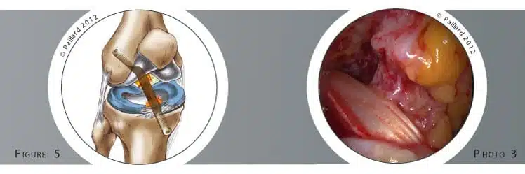 Qu’est ce qu’une ligamentoplastie du croisé antérieur sous arthroscopie? Définition par dr Paillard