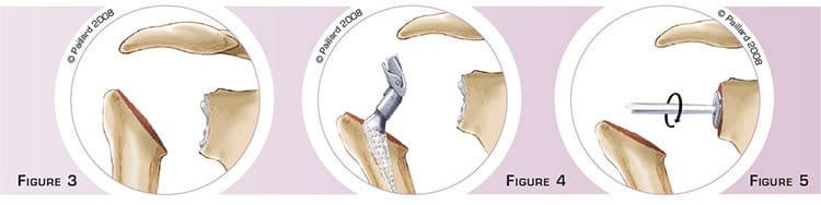Définition d'une prothèse totale de l’épaule par dr Paillard: Chirurgien orthopédique à Paris