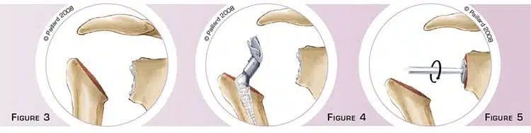Définition d'une prothèse totale de l’épaule par dr Paillard: Chirurgien orthopédique à Paris