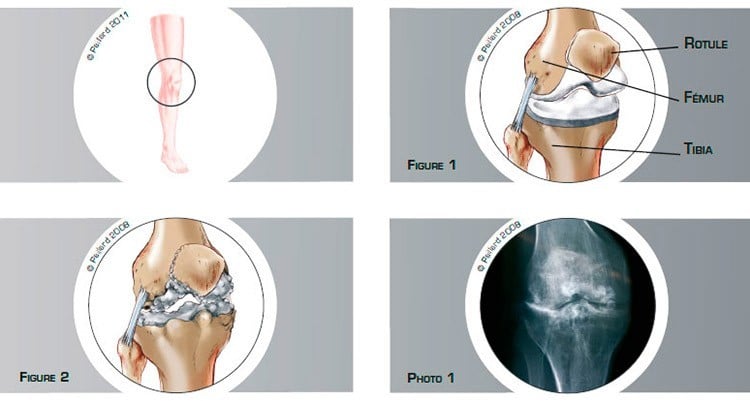 Qu’est ce qu’une arthrose du genou? Définition par dr Paillard
