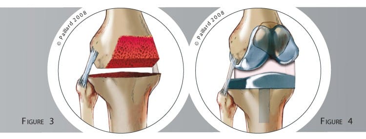 Qu’est ce qu’une prothèse totale du genou? Définition par dr Paillard