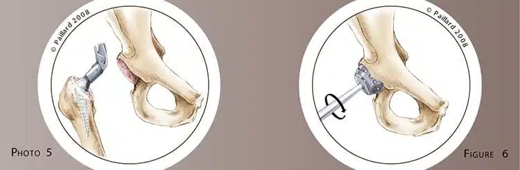 Chirurgie de la hanche à Paris: Prothèse totale de la hanche - Dr Paillard