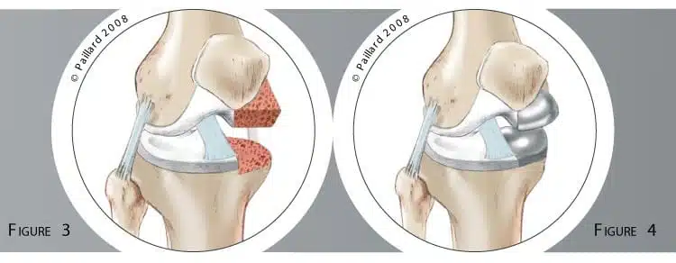 Qu’est ce qu’une prothèse unicompartimentale du genou? Définition par dr Paillard