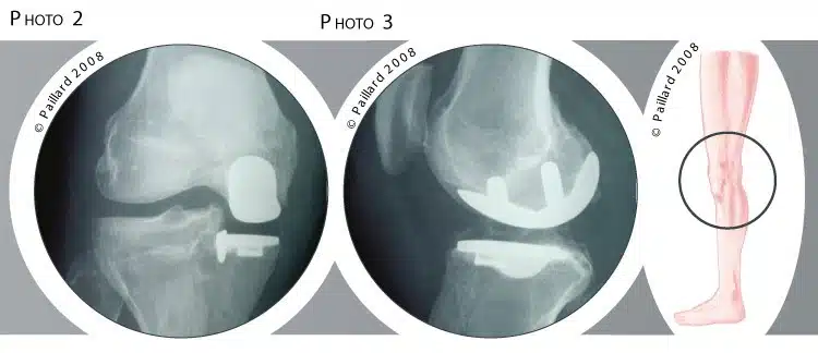 Traitement de la rupture du ligament croisé antérieur à Paris - Dr Paillard