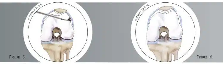 Qu’est-ce qu’une chirurgie de recentrage rotulien? Définition par dr Paillard