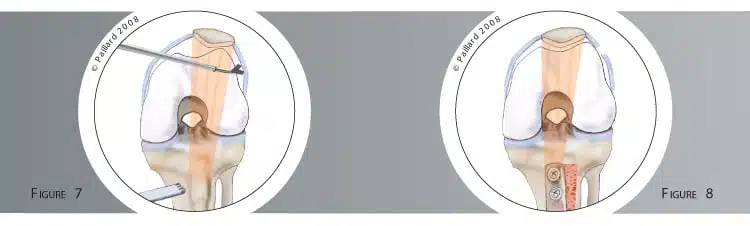 Traitement du dysfonctionnement rotulien à Paris - Dr Paillard