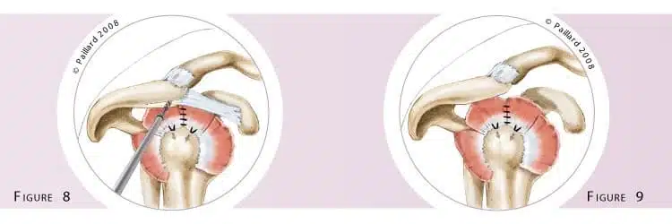 Réparation arthroscopique des tendons de l’épaule à Paris - Dr Paillard