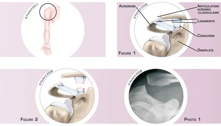 Qu’est ce qu’une luxation acromio-claviculaire? Définition par dr Paillard: Chirurgien orthopédique