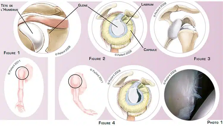 Qu’est ce qu’une épaule instable? Définition par dr Paillard: Chirurgien orthopédique