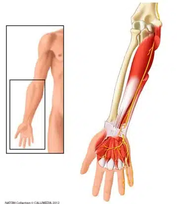 Qu’est-ce qu’une compression du nerf ulnaire (ou nerf cubital)? Définition par dr Paillard