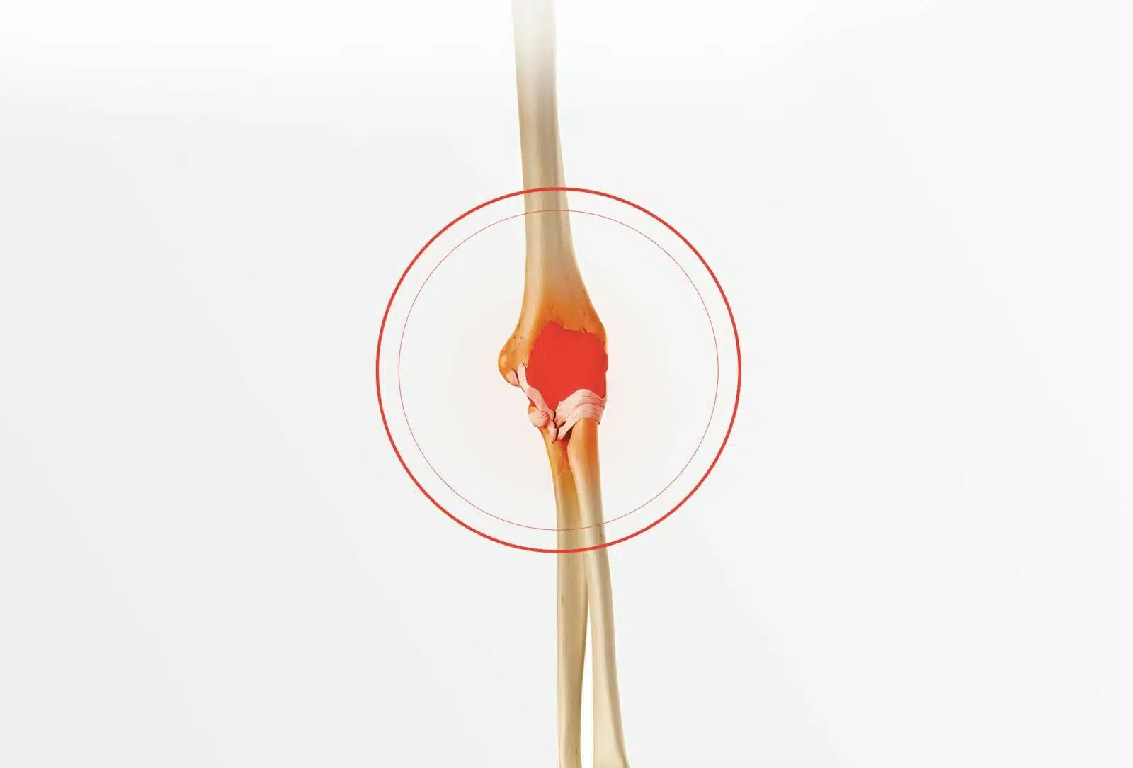 Chirurgie du coude à Paris: Arthrolyse du coude - Dr Paillard