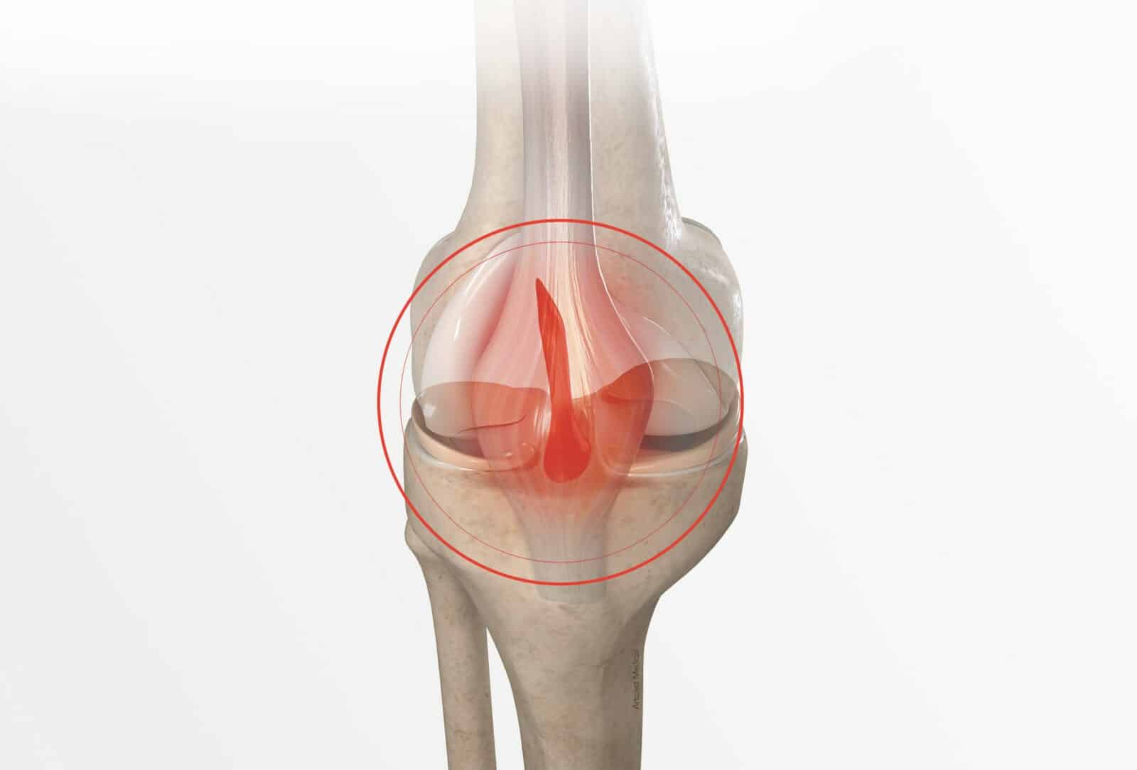 Chirurgie du genou à Paris: Arthrolyse du genou - Dr Paillard
