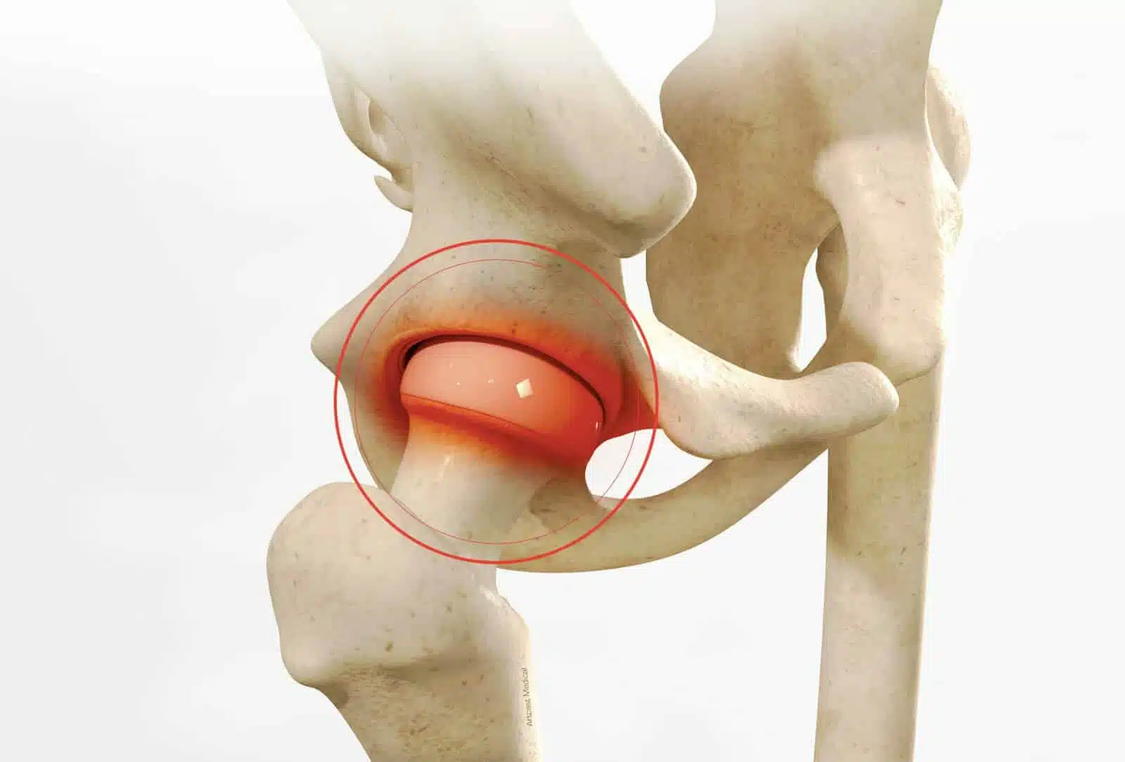 Chirurgie de la hanche à Paris: Arthroscopie de la hanche - Dr Paillard