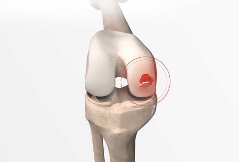 knee-cartilage-surgery-doctor-philippe-paillard-office