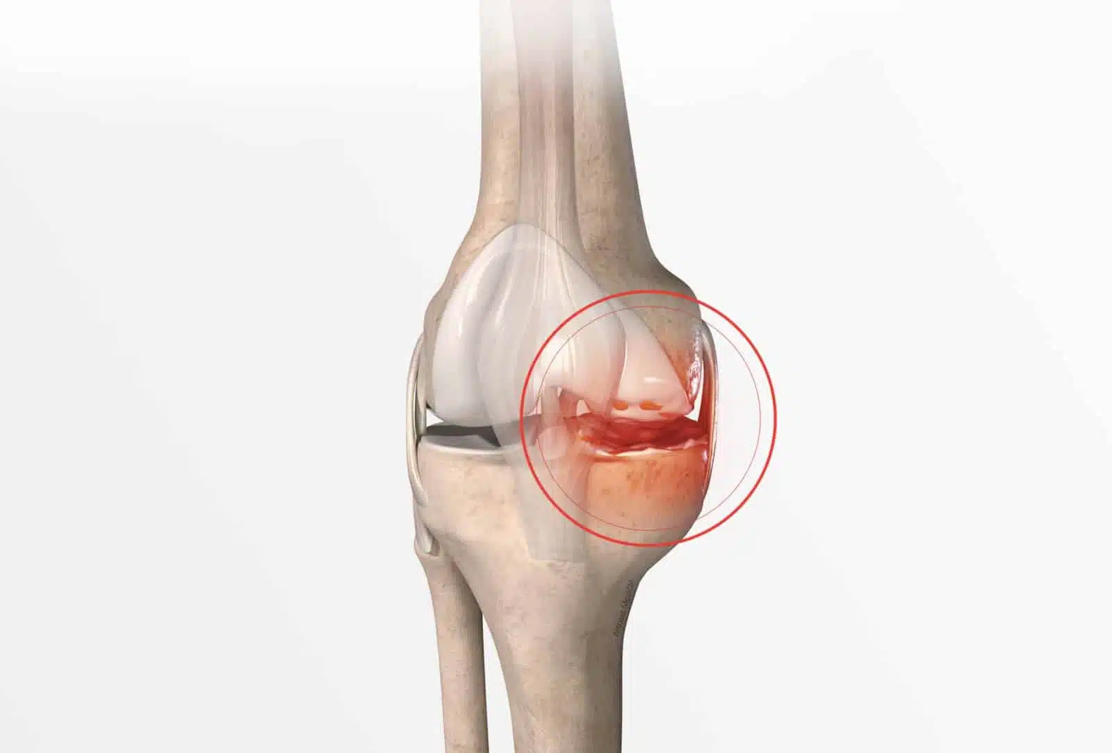 Chondropathie (rotulienne, fémoro patellaire, fémoro tibiale): Traitement à Paris