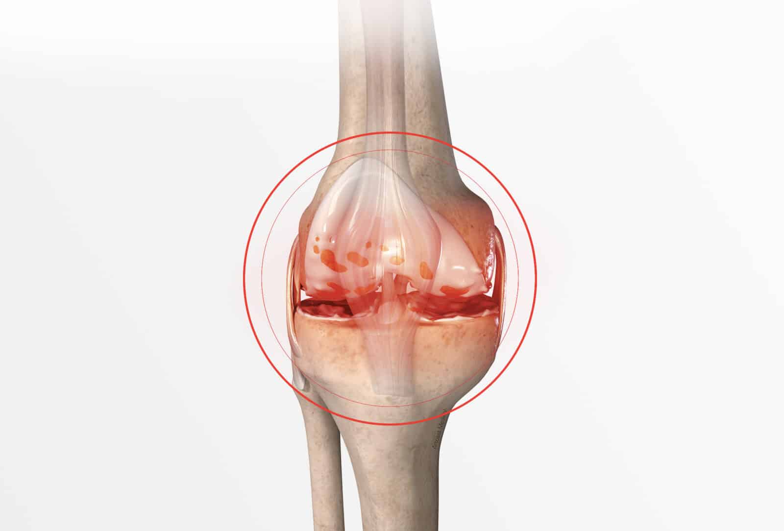 Traitement des complications liées aux prothèses de genou à Paris - Dr Paillard