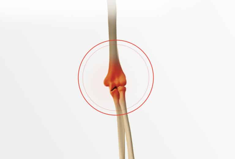 Symptômes et diagnostic de l'épicondylite du coude | Dr Paillard