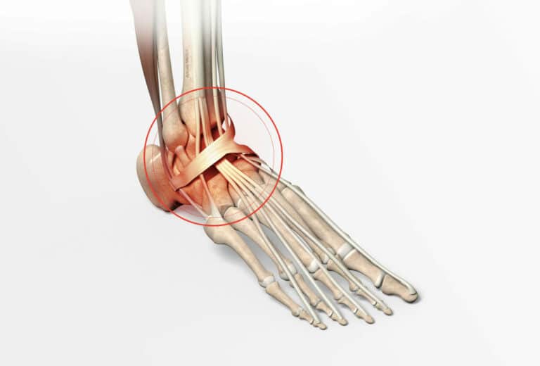 Symptômes et diagnostic de la fracture de cheville Dr Paillard