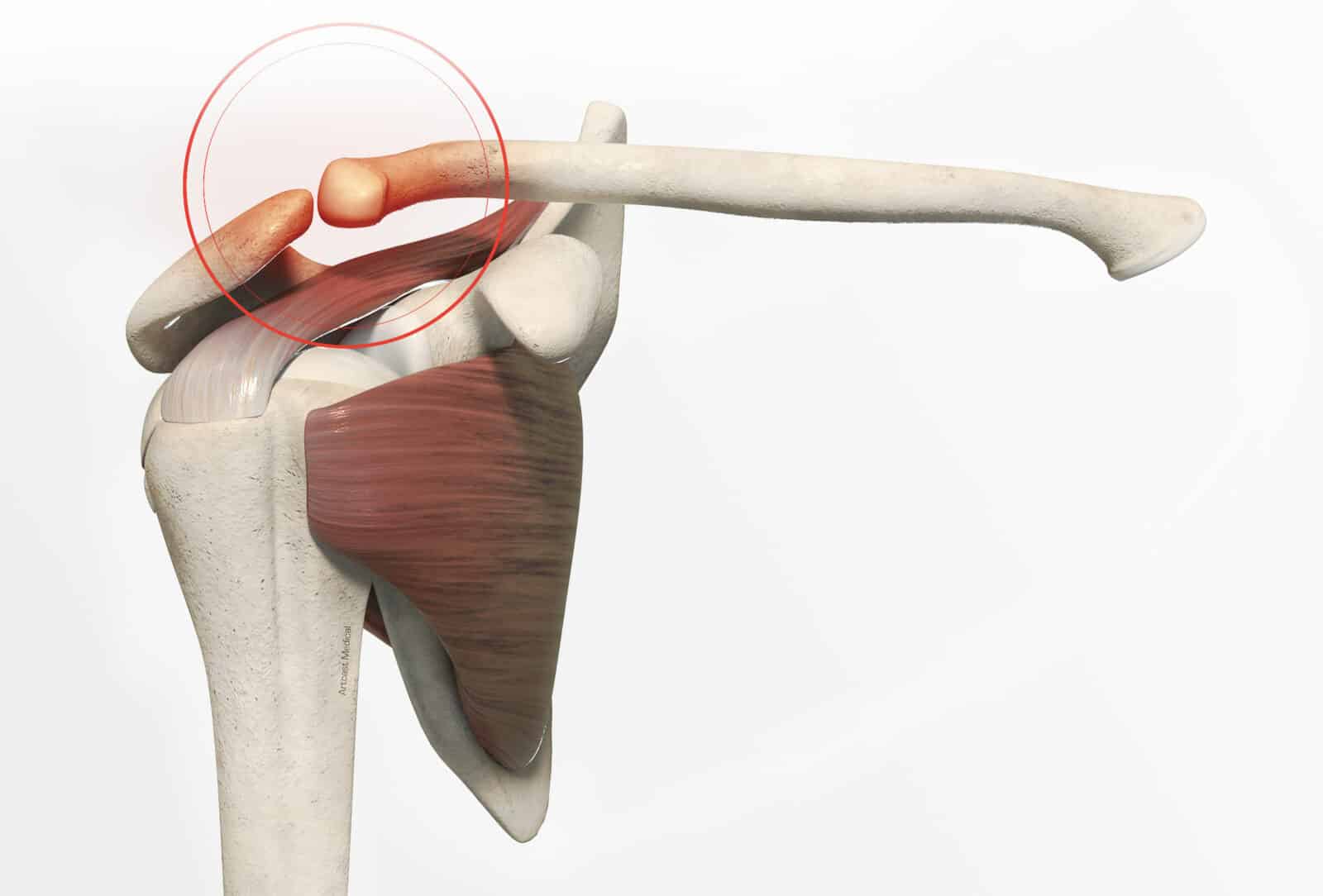 Traitement fracture de la clavicule à Paris - Dr Paillard: Chirurgien orthopédique