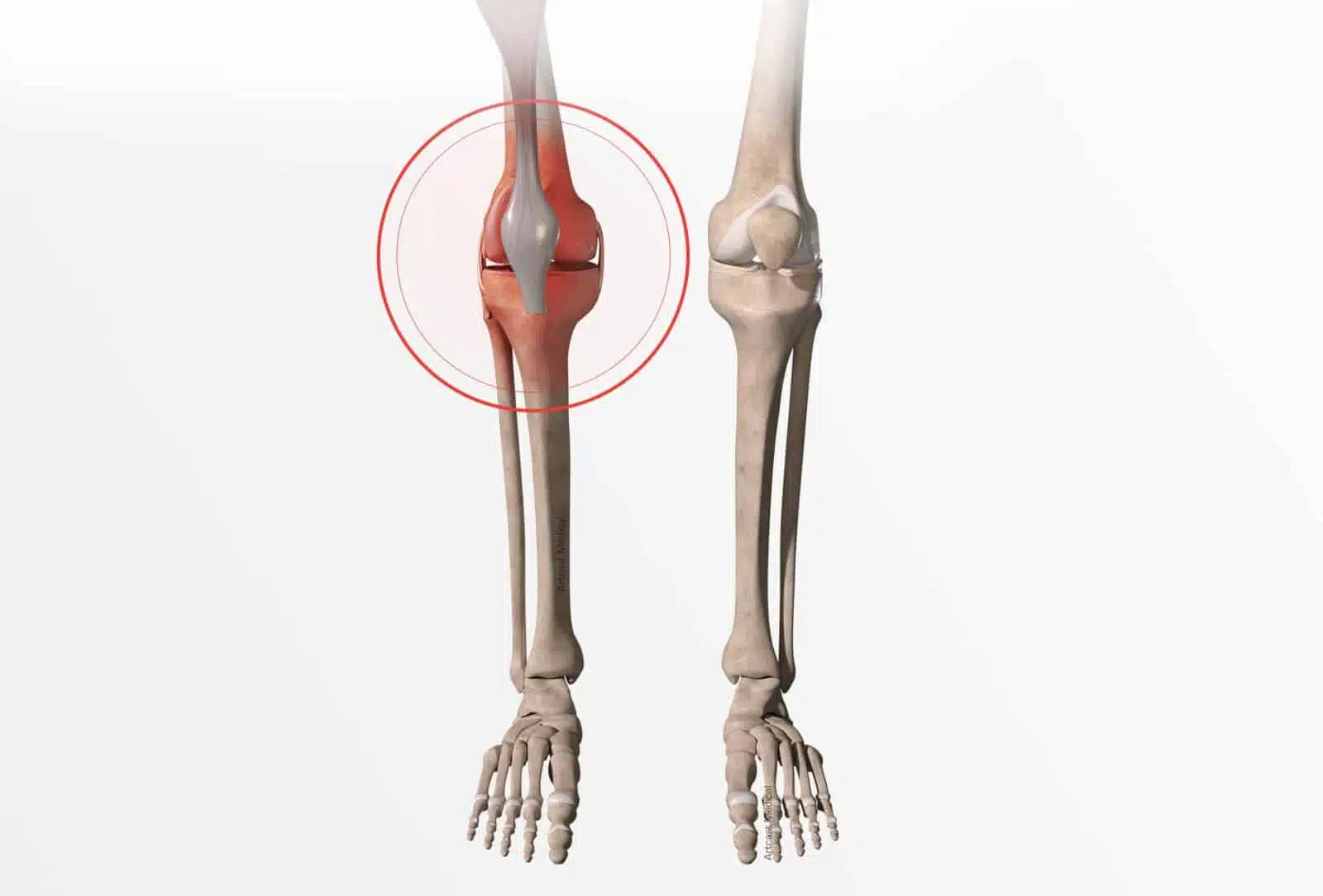 Traitement fracture du genou (fracture du plateau tibial et de la rotule) à Paris