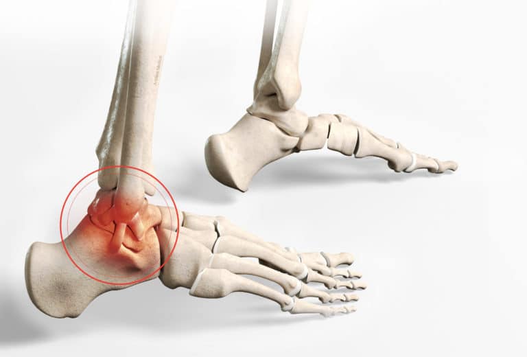 Ankle ligament reconstruction | Doctor Philippe Paillard Office