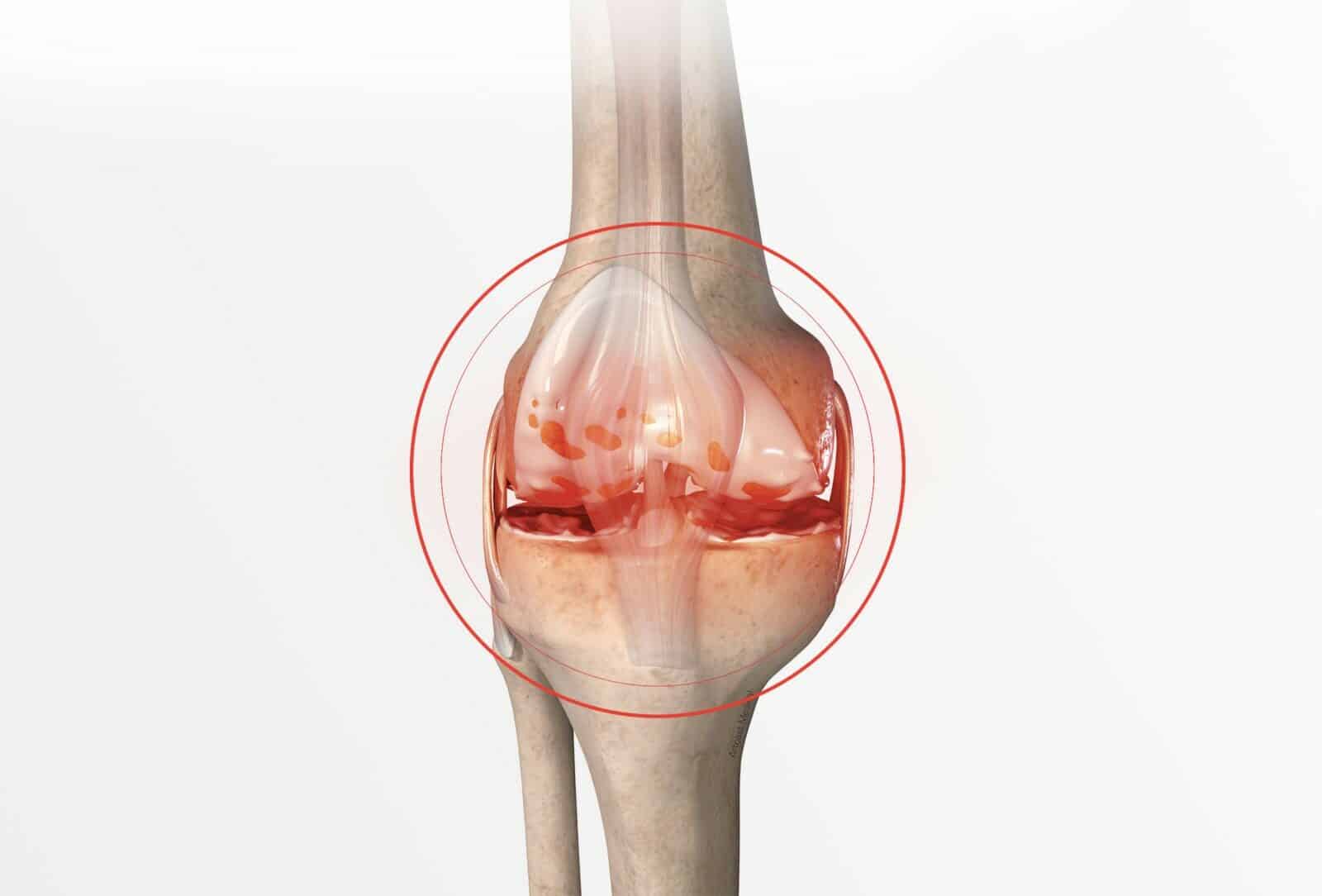Prothèse totale du genou (Chirurgie du genou) à Paris - Dr Paillard