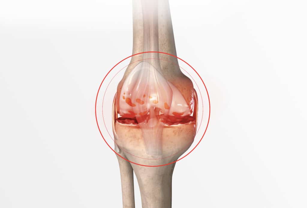 knee replacement Doctor Philippe Paillard Office