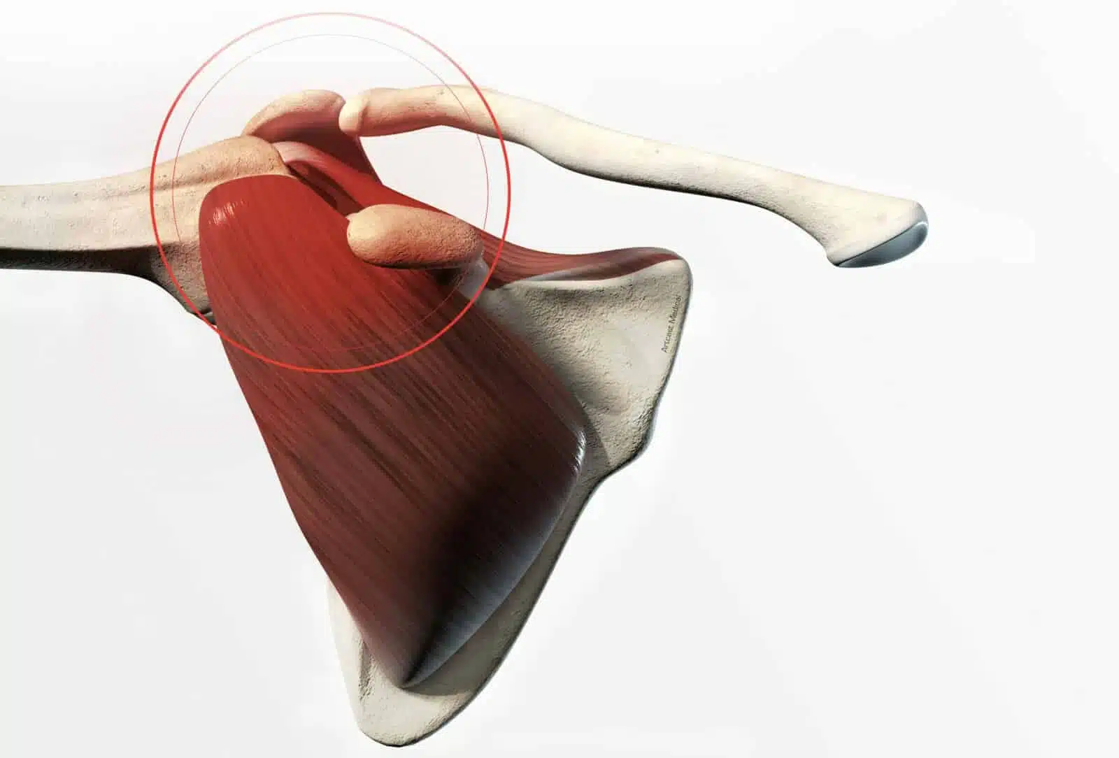 Chirurgie de l’épaule à Paris: Réparation de la coiffe des rotateurs - Dr Paillard Paris