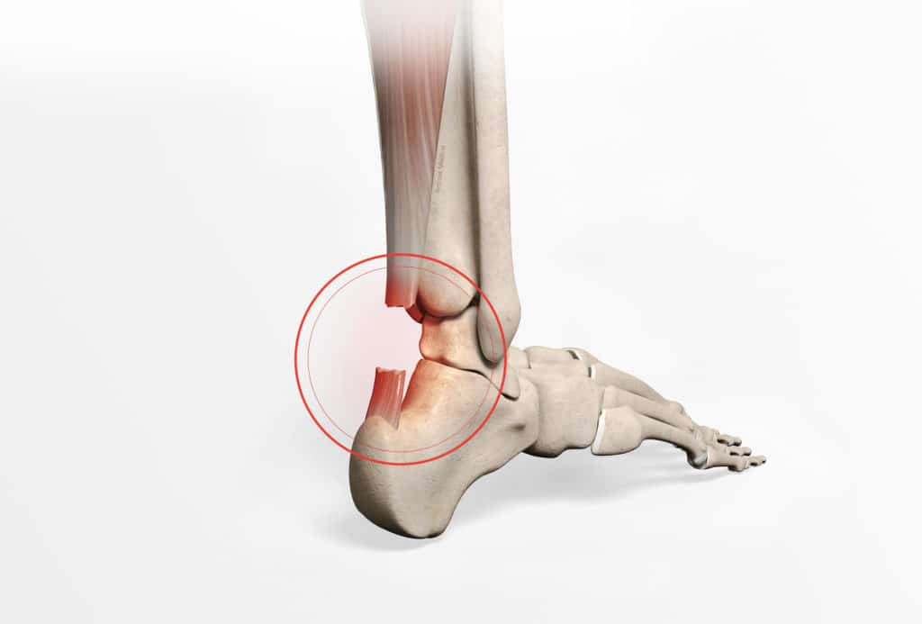 Achilles tendon repair | Doctor Philippe Paillard Office