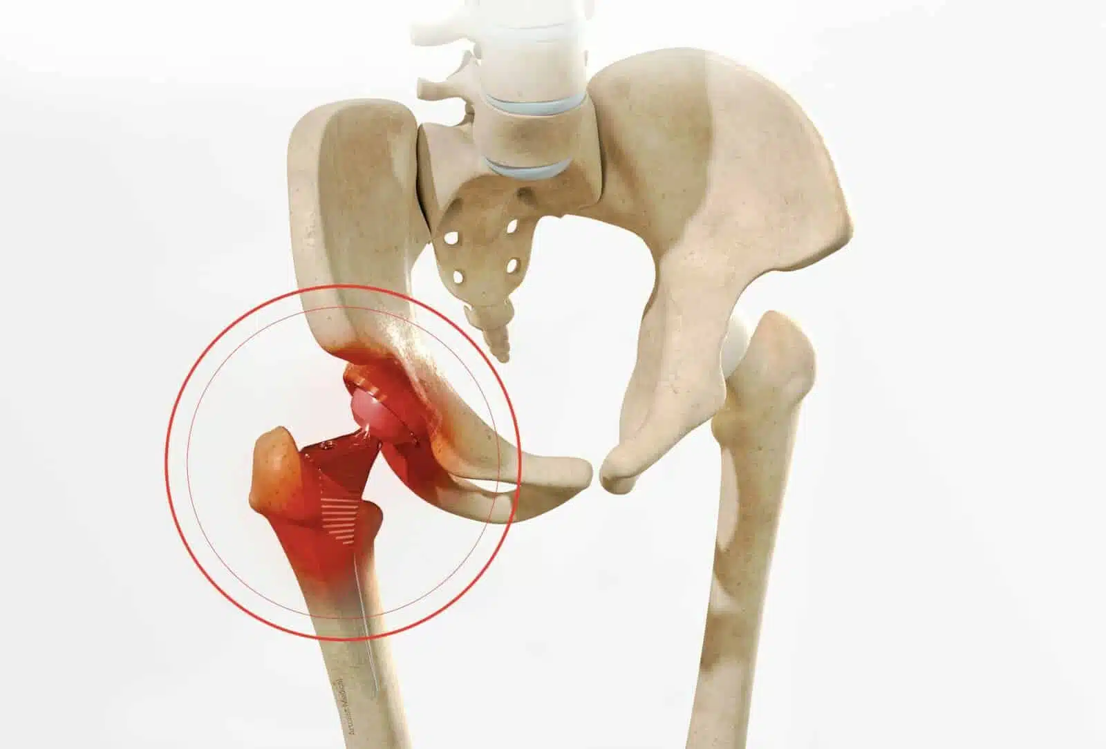 Revision hip replacement | Doctor Philippe Paillard Office