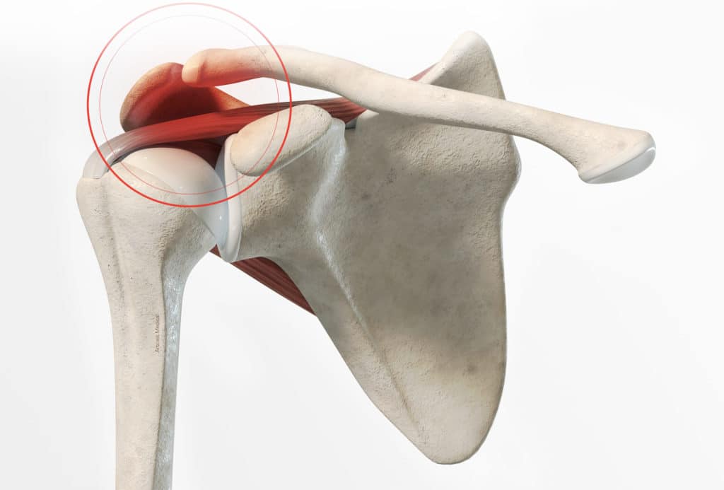 Résection acromi claviculaire à Paris Dr Paillard orthopédiste