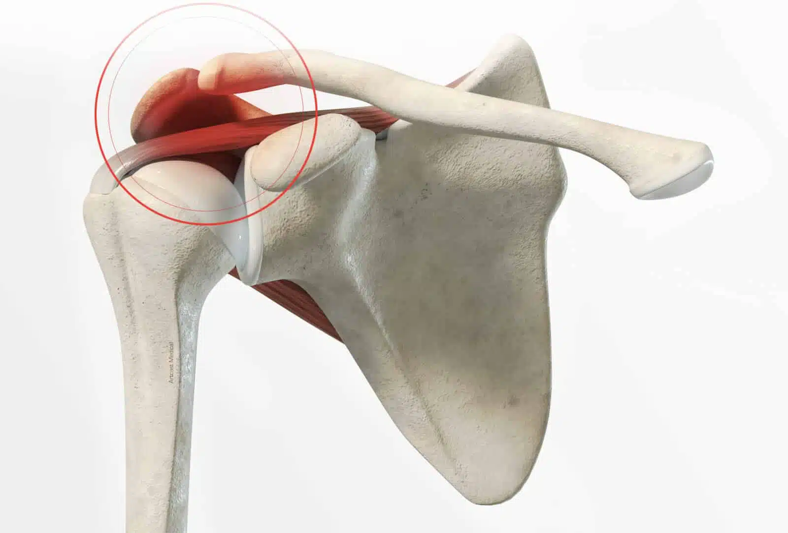 Chirurgie de l’épaule à Paris: Résection acromio claviculaire - Dr Paillard